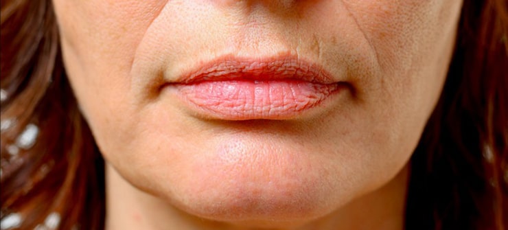 رفع چروک دور لب