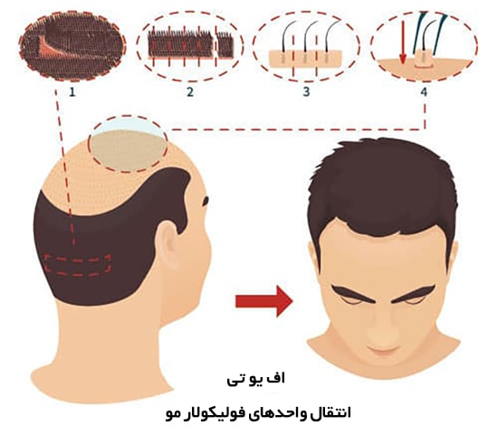 روش انتقال واحد‌های فولیکولی