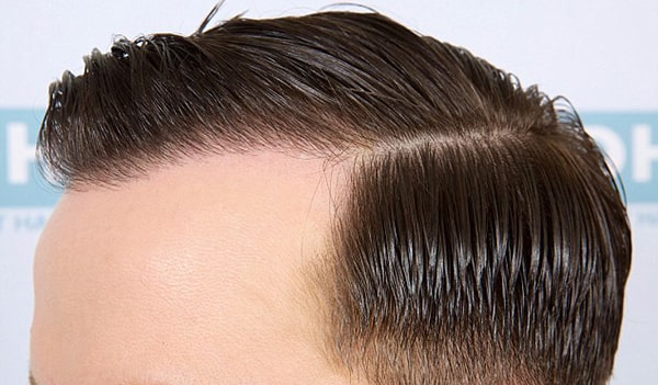 ریکاوری بعد از کاشت مو به روش FUE چگونه است