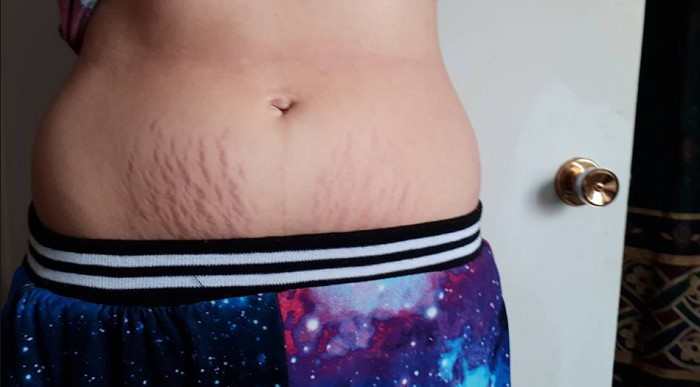 ترک پوستی درمان استرچ مارک بدن با کرم، میکرونیدلینگ و لیزر