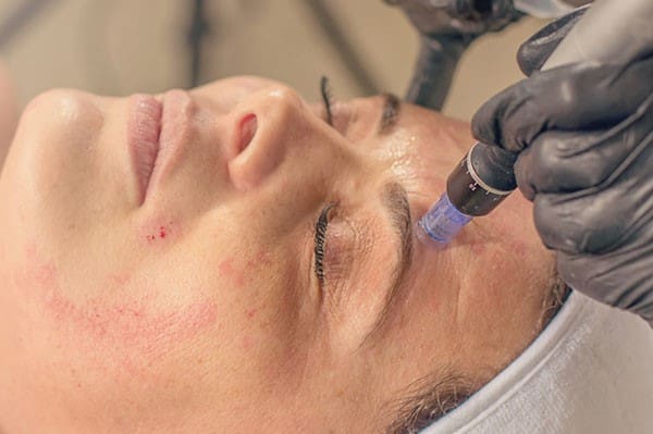 کاربردهای ضد پیری و جوان سازی پوست مزوتراپی چیست؟