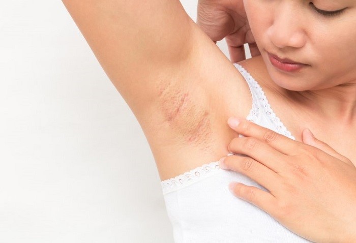 تیرگی زیر بغل نشانه چیست؟ رفع سیاهی زیر بغل با دارو، پماد و لیزر